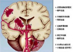 脑室出血的新管理应用模式