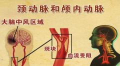 颈部动脉粥样硬化产生的原因及治疗预防新措施